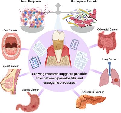 The Crossroads of Periodontitis and Oral Squamous Cell Carcinoma: Immune Implications and Tumor Promoting Capacities